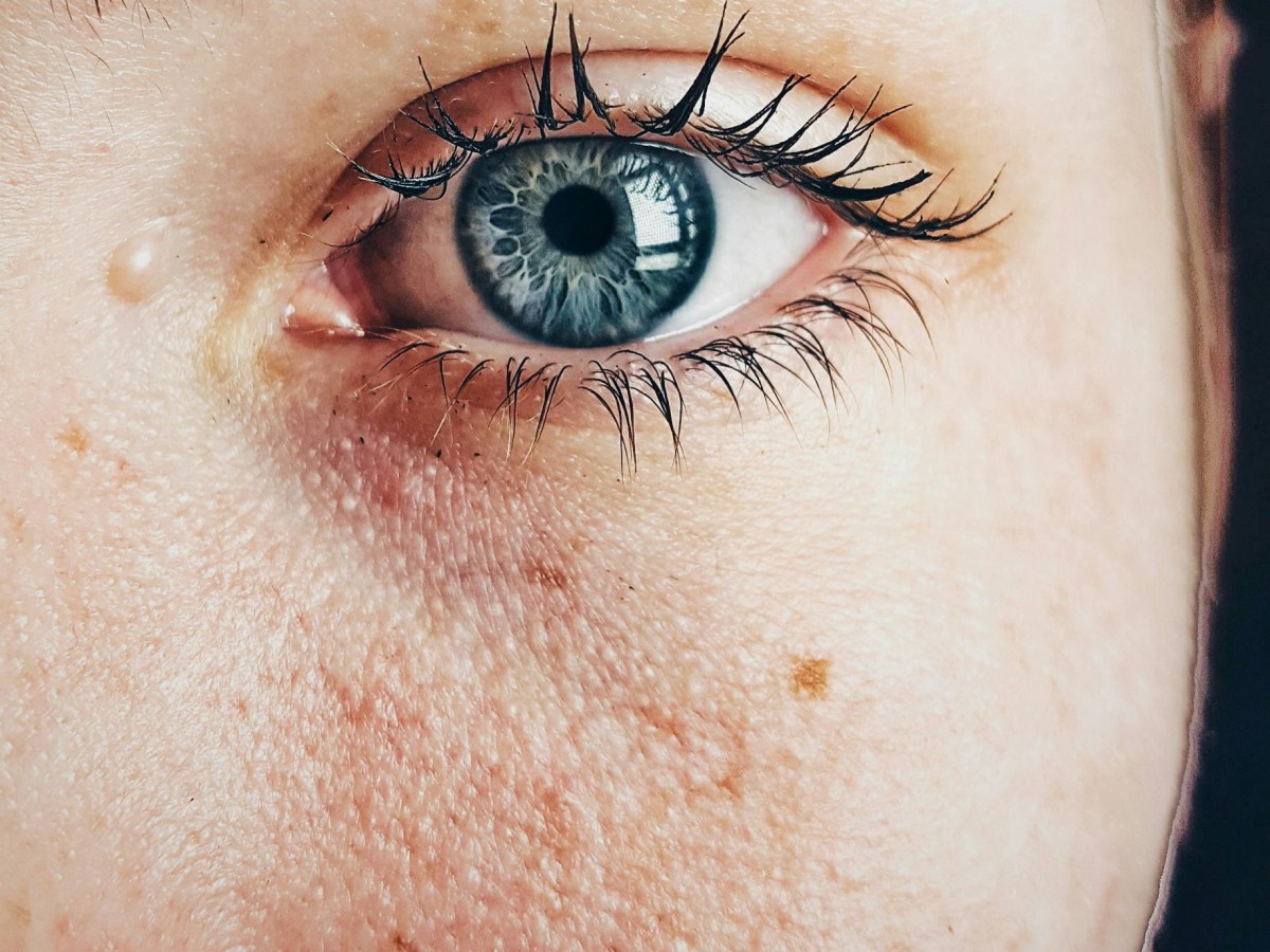 The Ultimate Guide to Understanding Pigmentation: Causes, Treatments, and&nbsp;Prevention